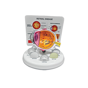 Retinal-Disease-Eye-Model