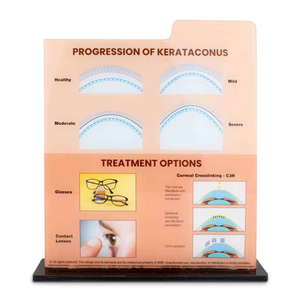 Keratoconus Patient Counseling Tool - 1