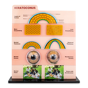 Keratoconus-Patient-Counseling-Tool